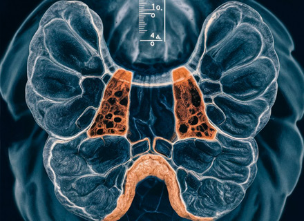 scintigraphie thyroïdienne